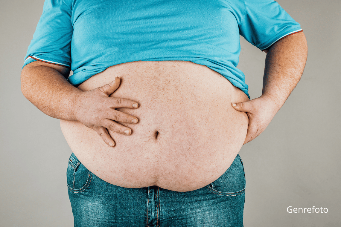 Fedmealarm: Svær overvægt stiger markant i Tønder og resten af Sønderjylland