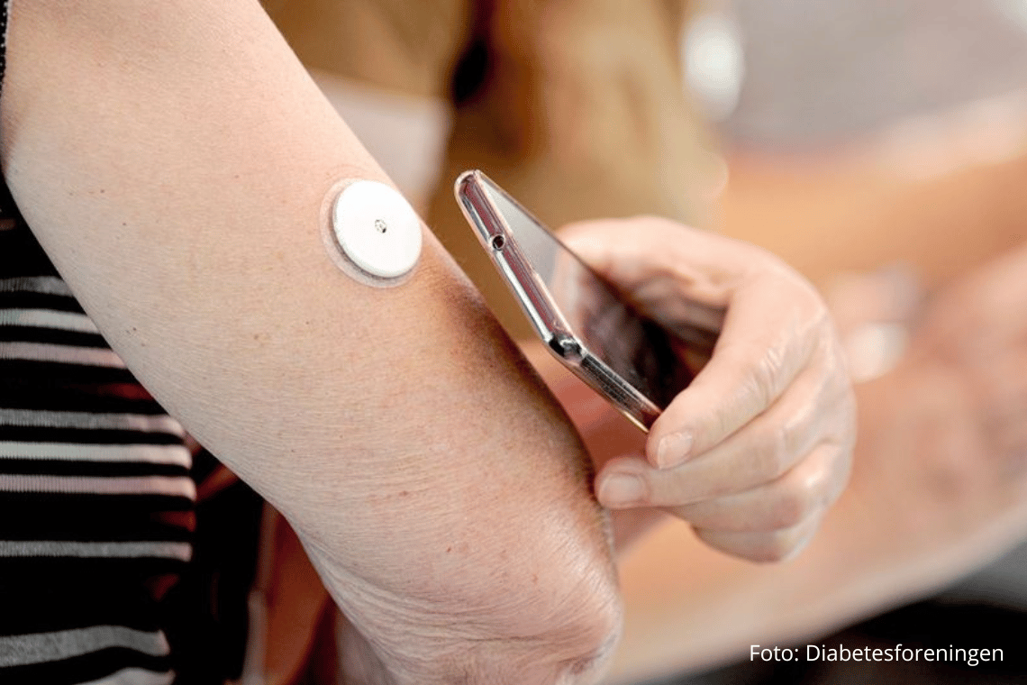 Trods diabetesrekord: I Tønder er sensorer i praksis uden for rækkevidde for 3.700 borgere
